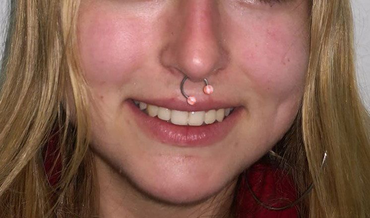 Ortopedia ortodoncia transposición