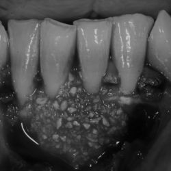 Caso de cirugía periodontal