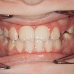 Caso ortopedia y ortodoncia