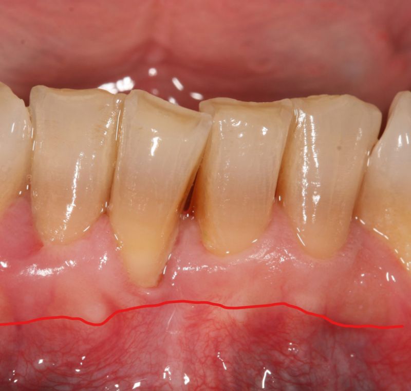 Caso de cirugía periodontal