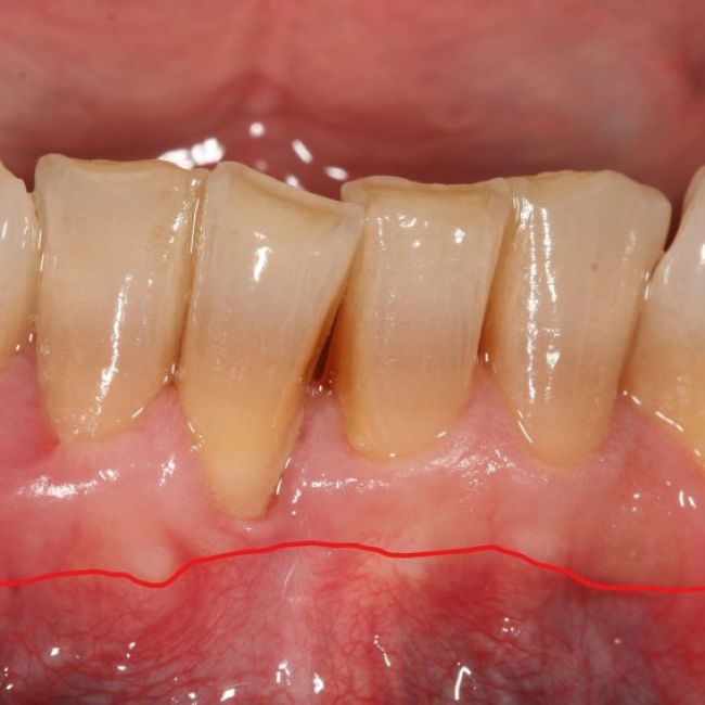 Cirugía periodontal