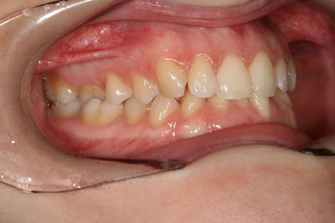 Caso ortodoncia damon 1