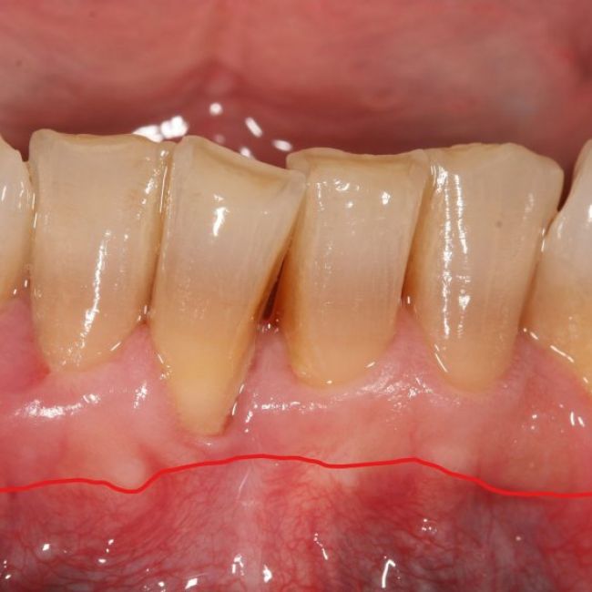 Caso de cirugía periodontal