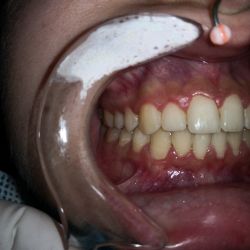 Ortopedia ortodoncia transposición