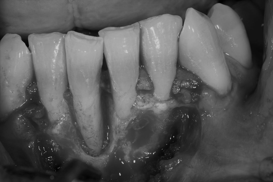 Caso de cirugía periodontal