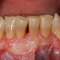 Caso de cirugía periodontal