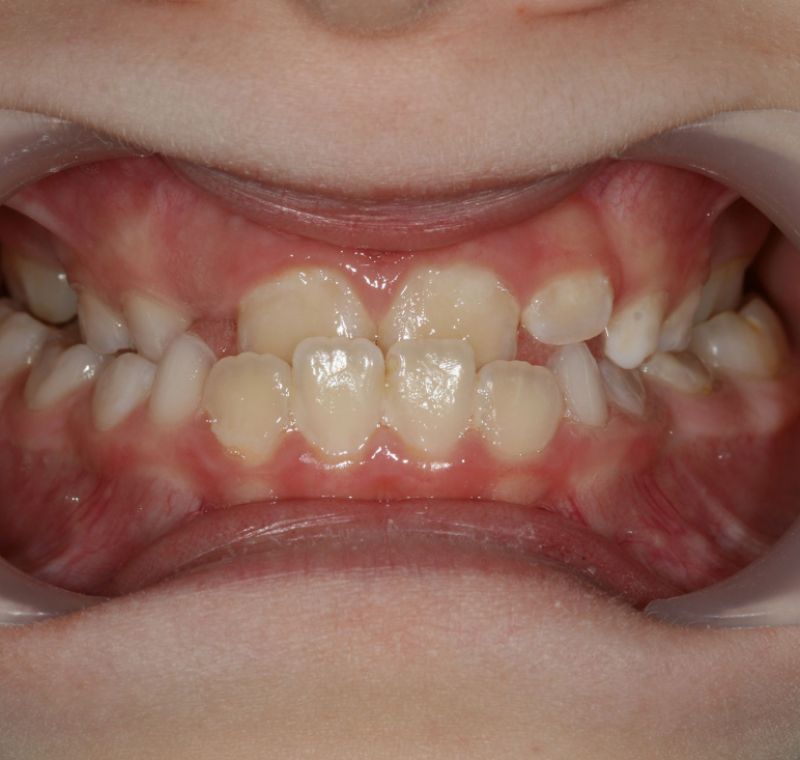 Caso ortopedia y ortodoncia