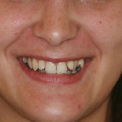 Caso ortodoncia damon 2