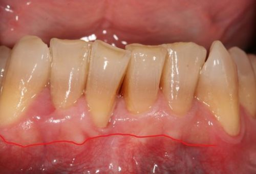 Caso de cirugía periodontal