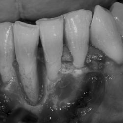 Caso de cirugía periodontal