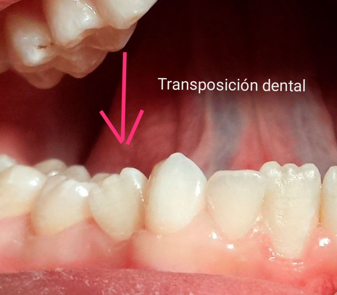 Ortopedia ortodoncia transposición