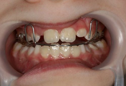 Caso ortopedia y ortodoncia