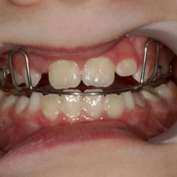 Caso ortopedia y ortodoncia