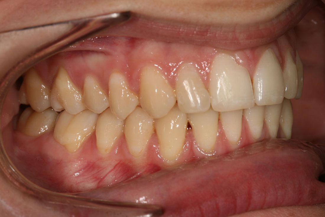 Caso ortodoncia damon 2