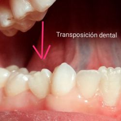 Ortopedia ortodoncia transposición