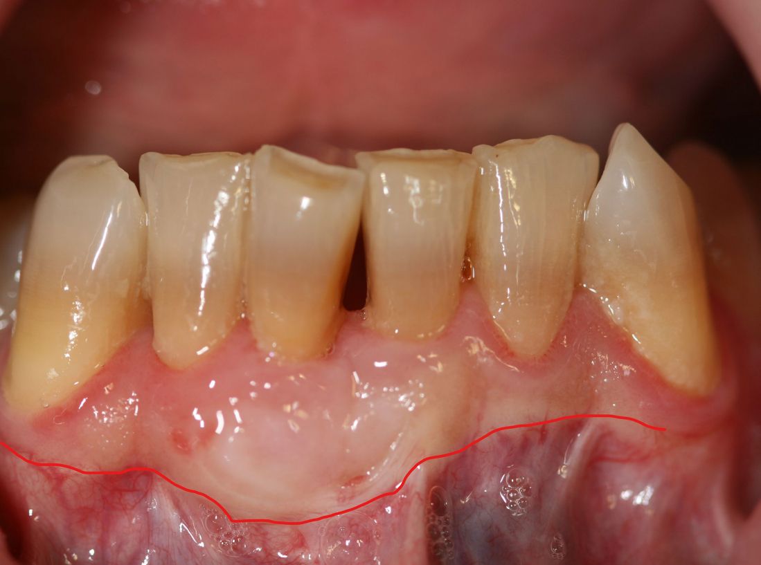 Caso de cirugía periodontal