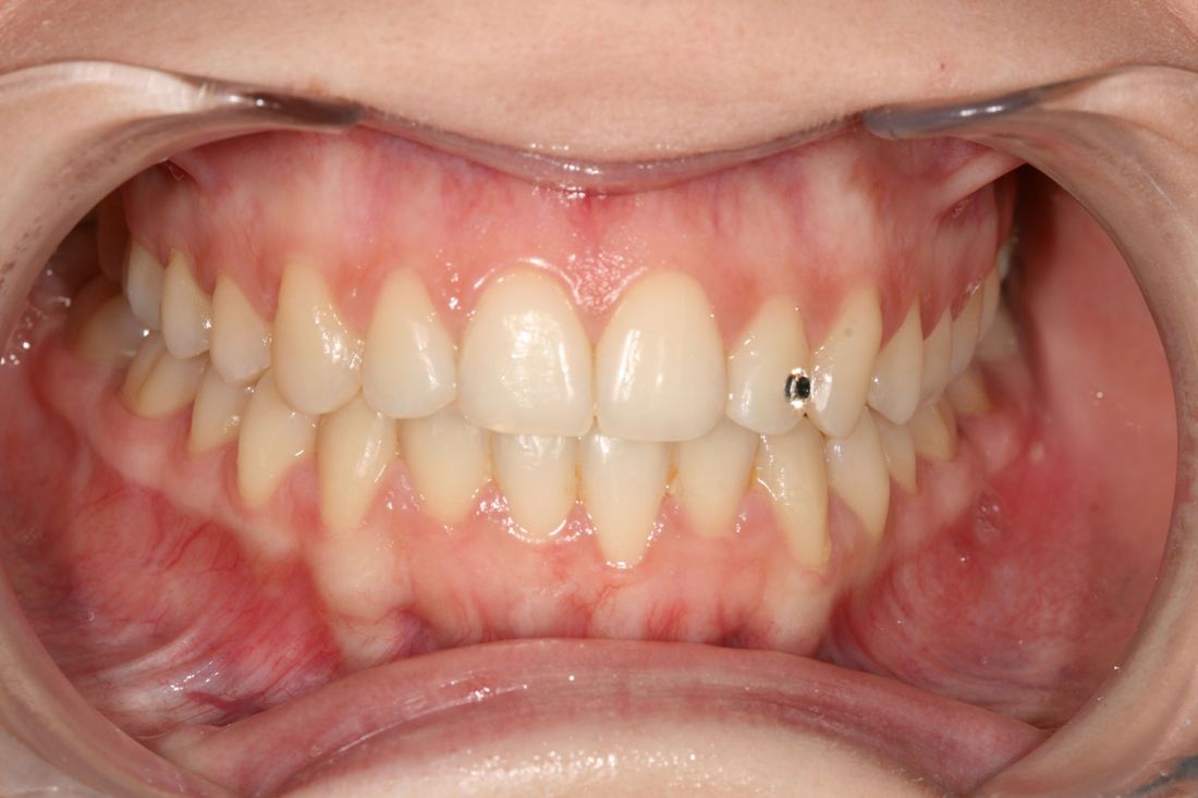 Caso ortodoncia damon 1