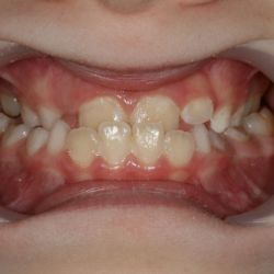 Caso ortopedia y ortodoncia