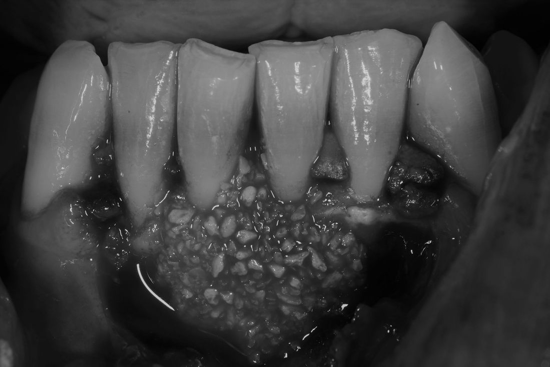 Caso de cirugía periodontal