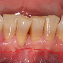 Caso de cirugía periodontal